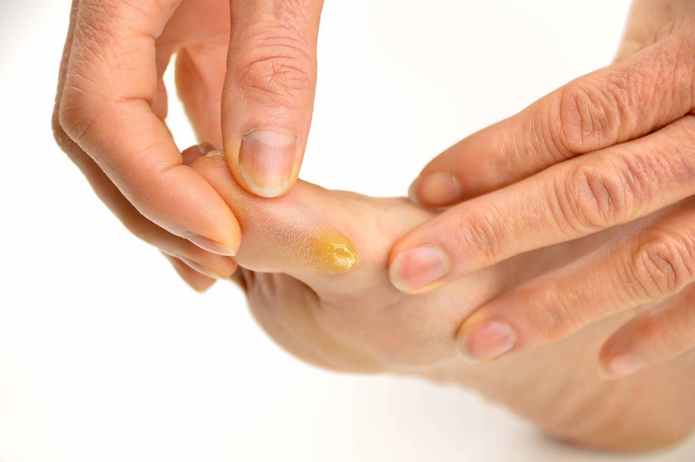 Hand and Foot Callus Treatment & Removal