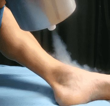 Cryotherapy for Plantar Warts
