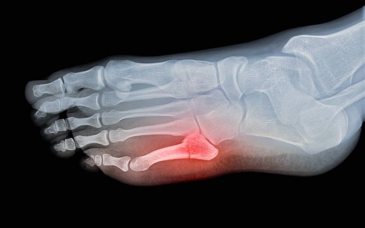 How To Treat A Broken Toe Fracture