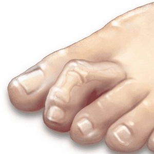 Hammertoe Surgery What To Expect