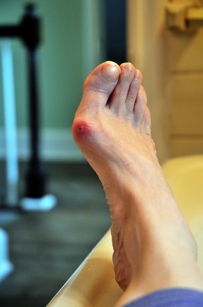 How to Alleviate Bunion Pain