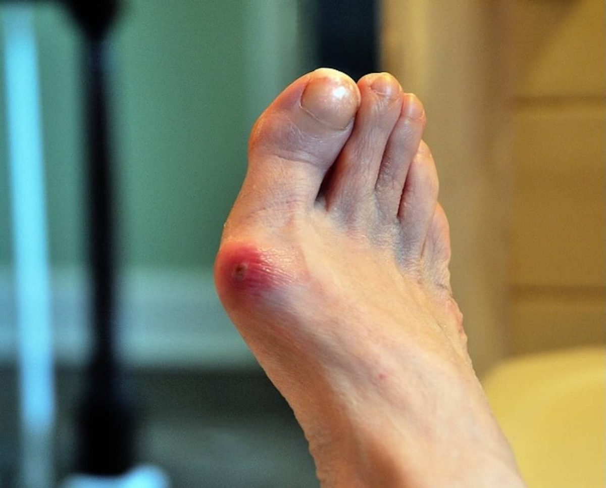 How To Alleviate Bunion Pain