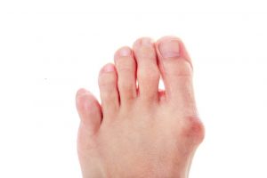 Foot Care: Bunions