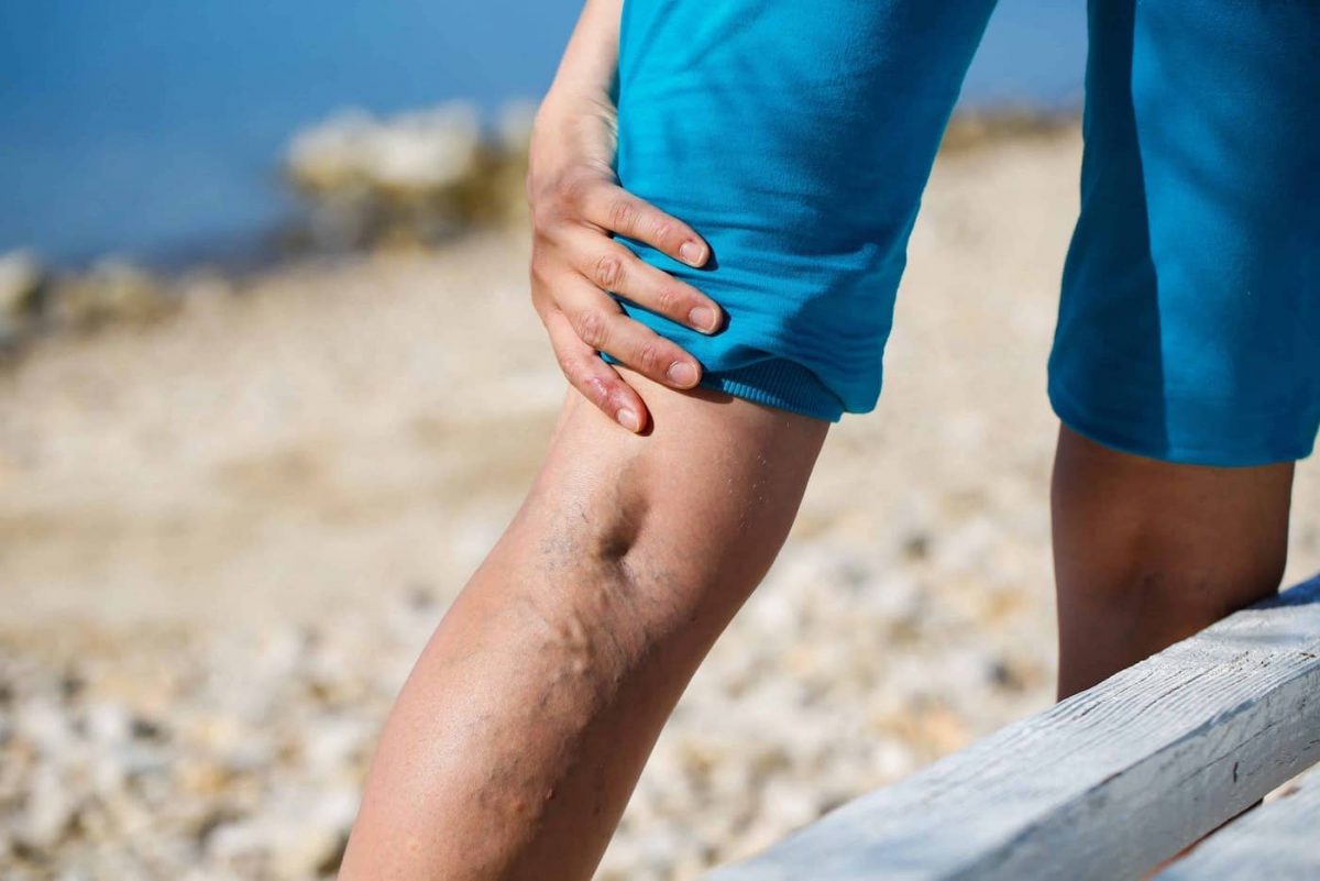 Signs You Have Varicose Veins