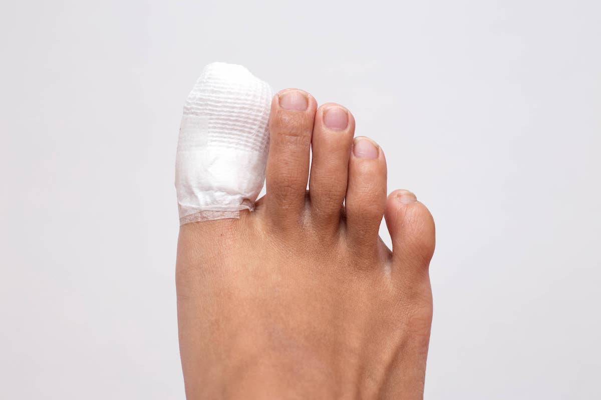 How To Remove an Infected Ingrown Toenail | Jaws Podiatry