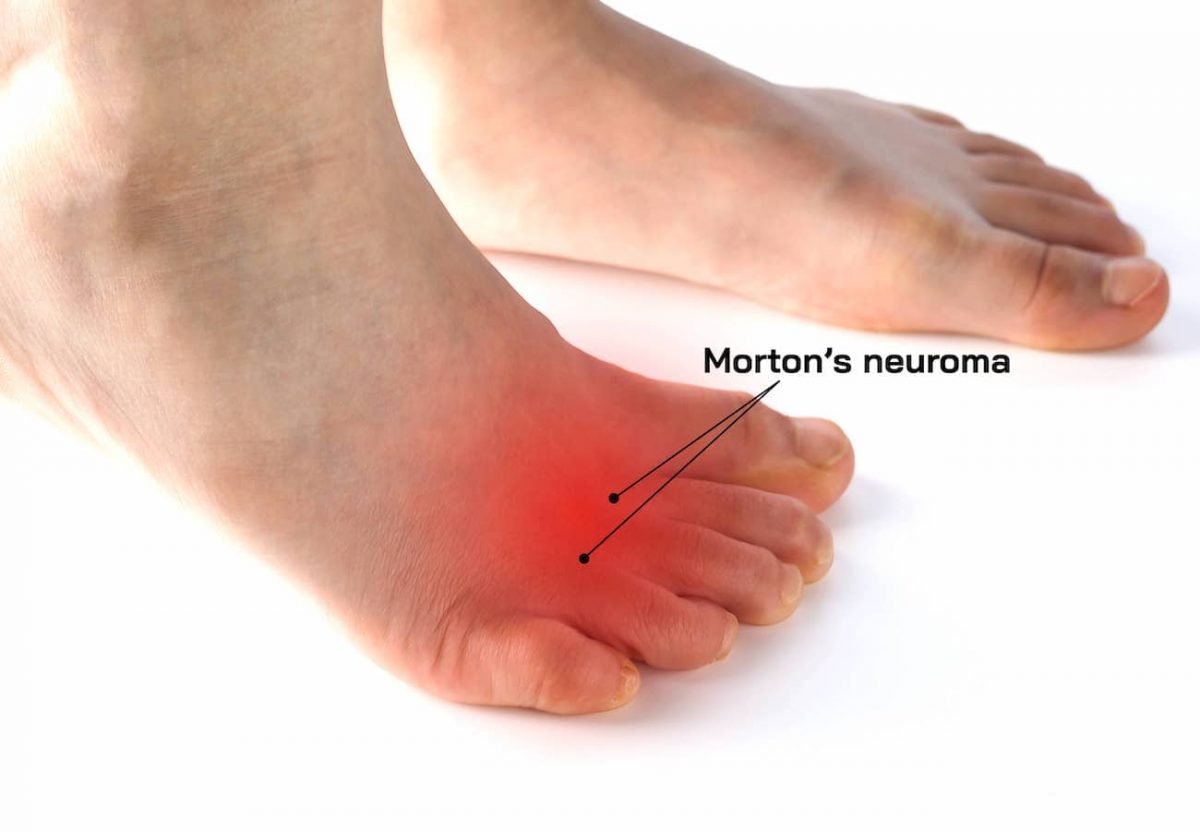 Morton’s Neuroma Surgery