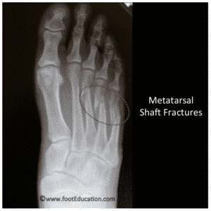 The Podiatric Doctor's Guide: Metatarsal Surgery - JAWS