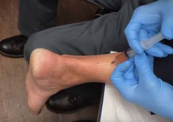 treating ACHILLES TEAR with PLATELET-RICH PLASMA + microtenotomy