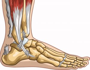 Achilles Tendonitis And Damage To Achilles Tendon Fibers