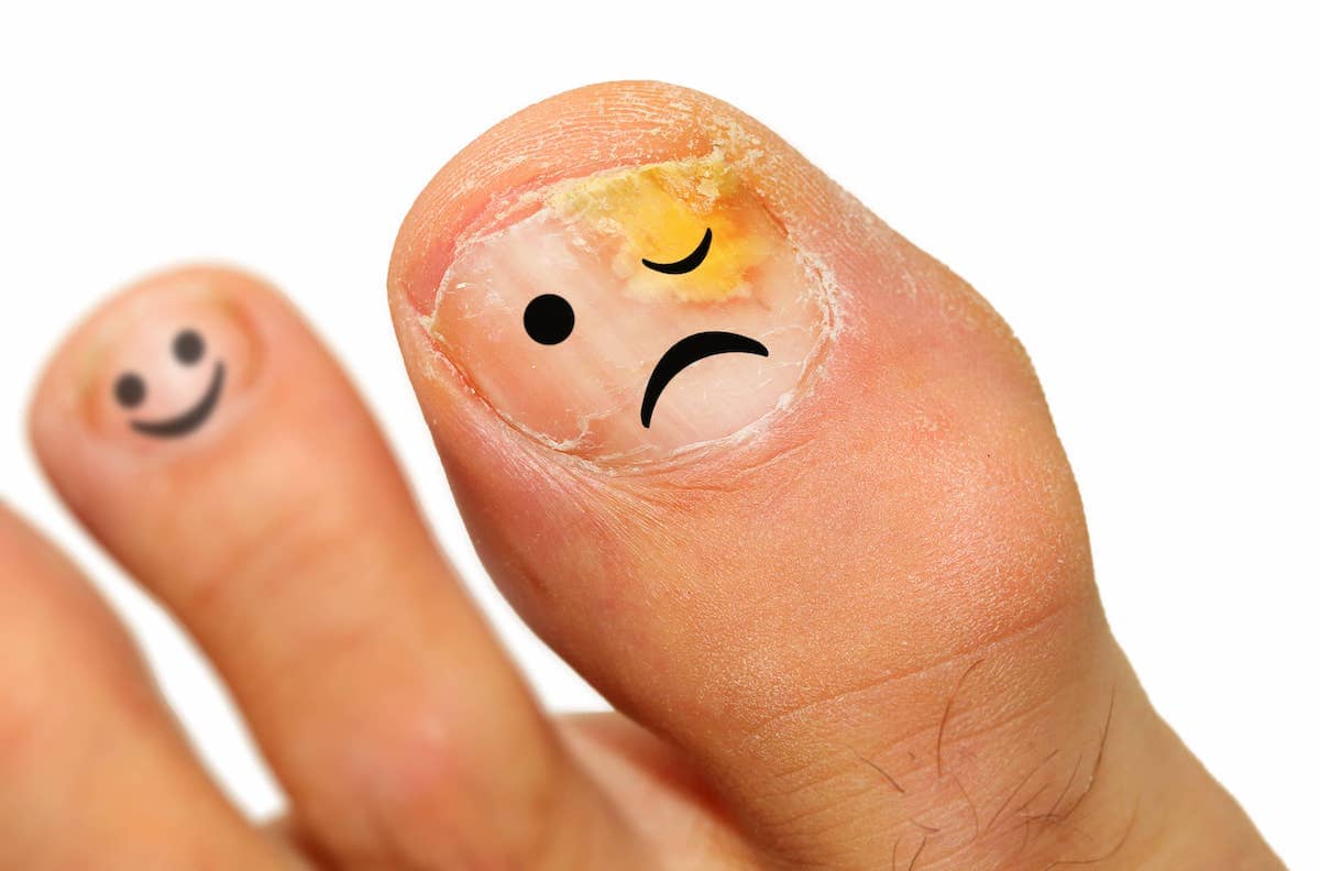 Why are my toenails yellow Causes and treatment