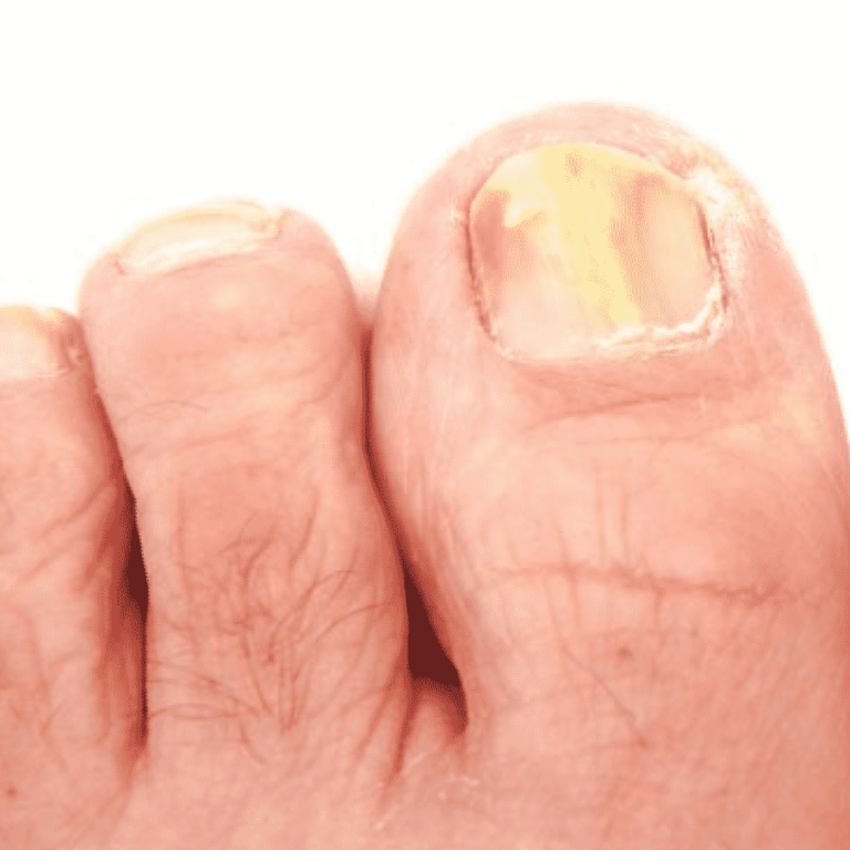 Dangers of Ignoring a Toenail Fungus Infection JAWS podiatry