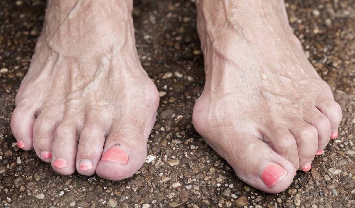 Hammertoe - Symptoms, Causes, Relief And Treatments