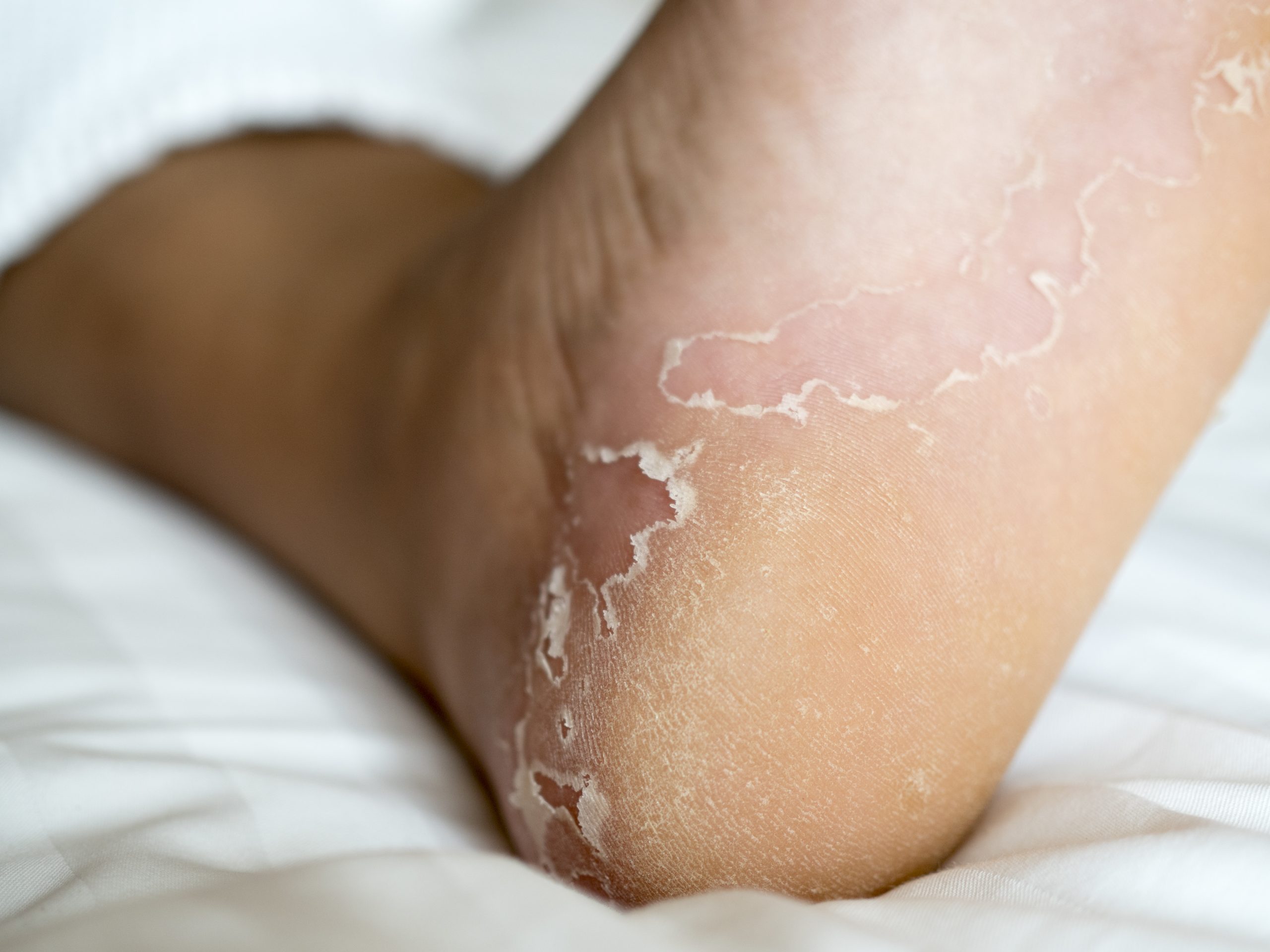 Burning feet can be a symptom of high uric acid | The Times of India