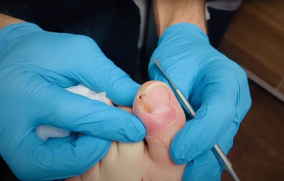 Infected Ingrown Toenail and Granuloma Removal