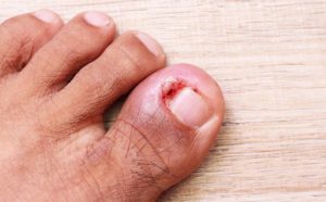 Why Antibiotics Won't Fix Your Ingrown Toenail