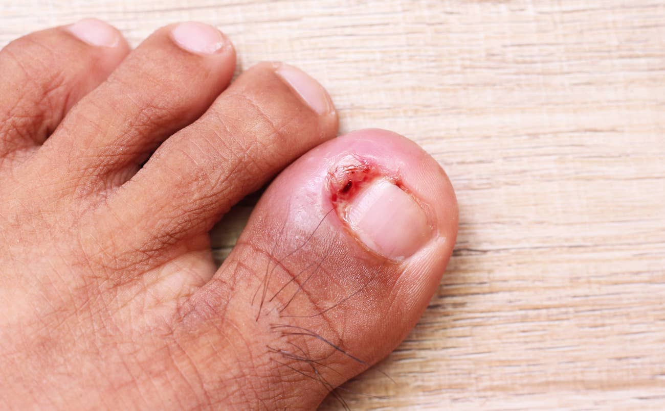 Infected Ingrown Toenail and Granuloma Treatment & Removal