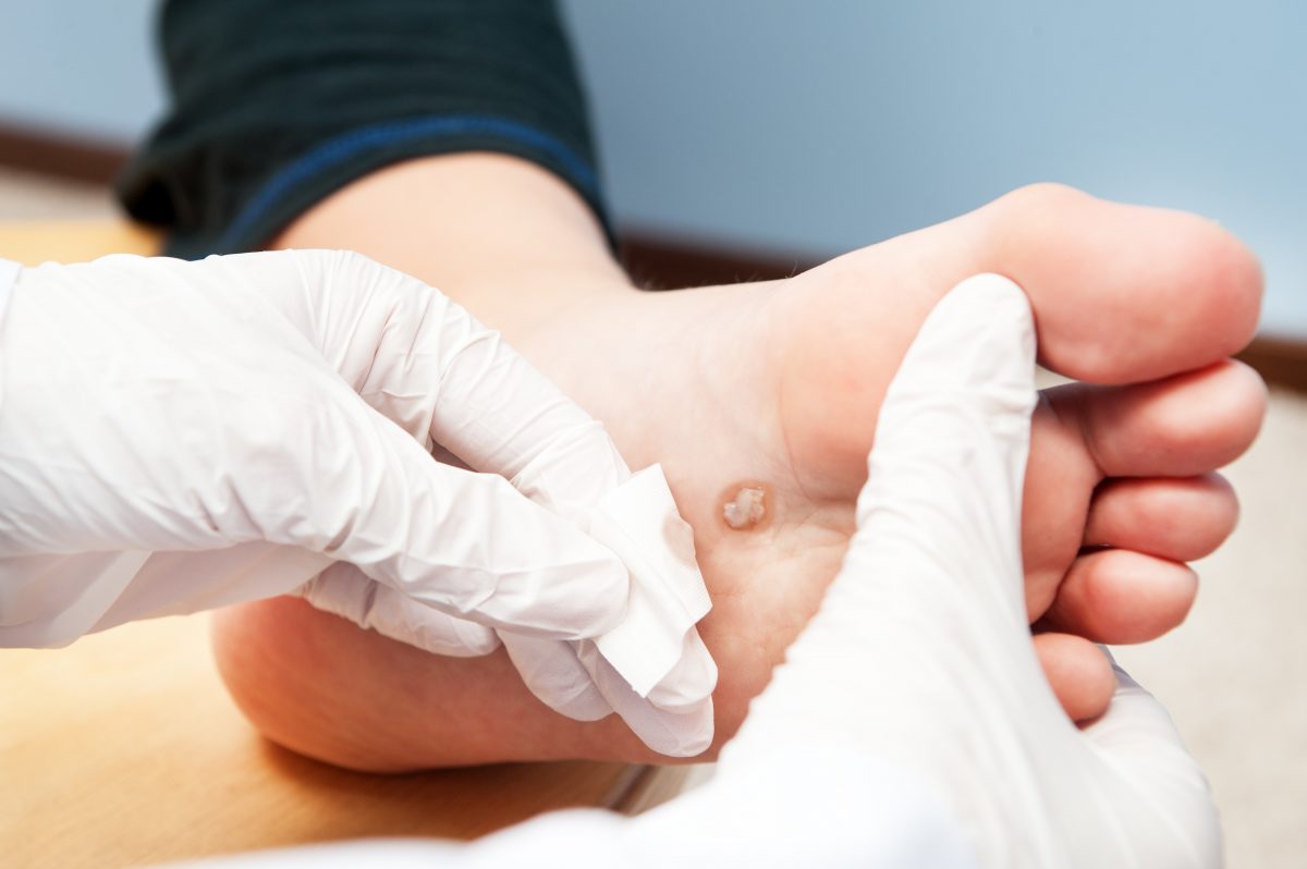 Preventative Podiatry: Diabetic Foot Ulcers