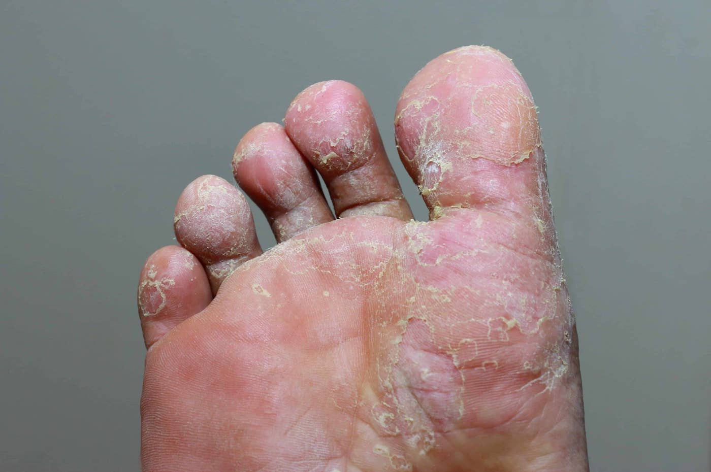 Fungal nail infection: diagnosis and management | The BMJ