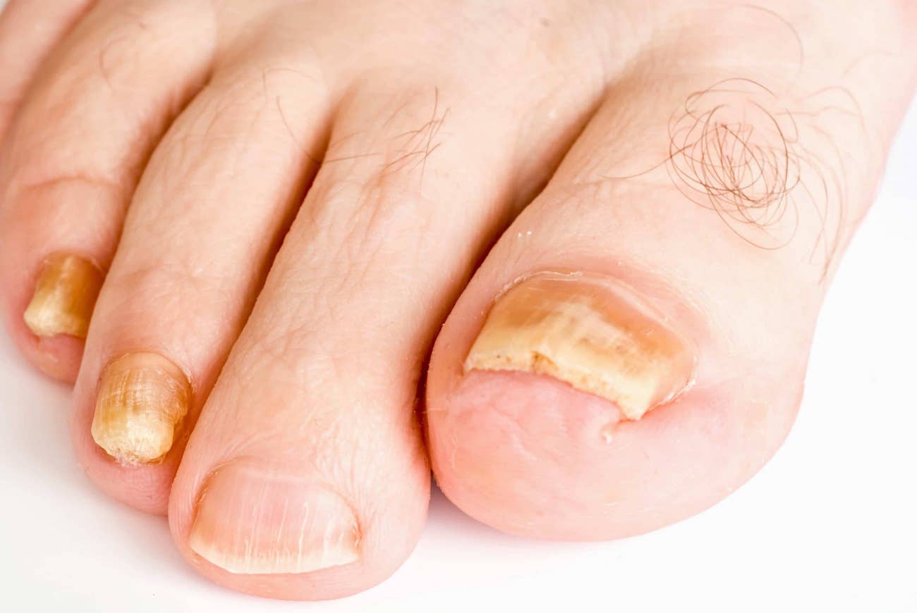 Nail Fungus Legs Disease Fungal Infection Nails Legs Finger Onychomycosis  Stock Photo by ©leravalera89 447157000
