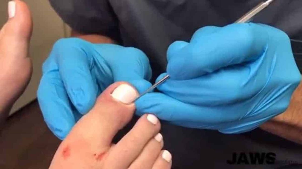 Ingrown Toenail Removal Abraham Wagner