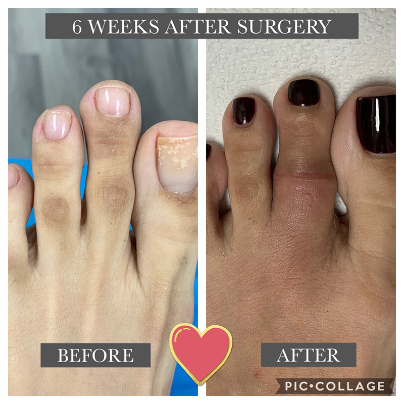 What is Aesthetic Toe-Shortening Surgery?