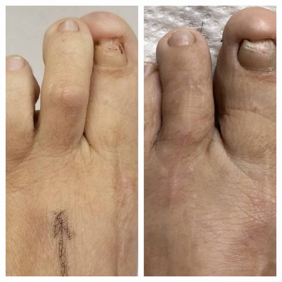 Toe Straightening Surgery Before And After