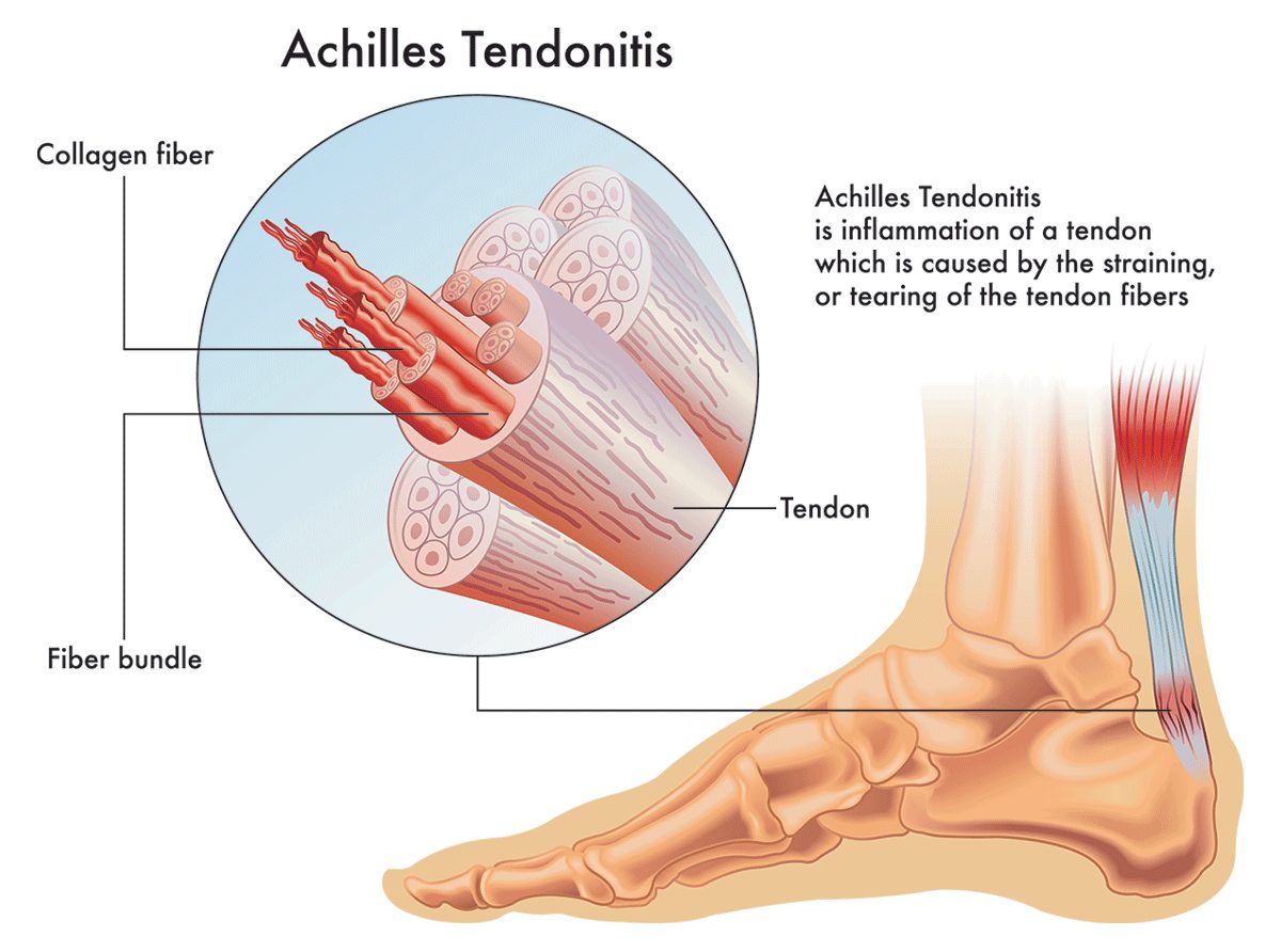 Treatments For Achilles Tendinitis | Physical Therapy | Symptoms