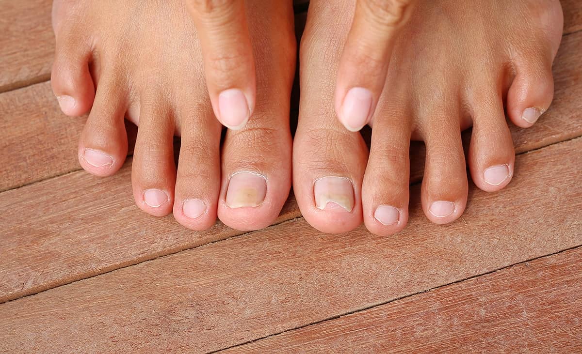 Staying one step ahead of toenail fungus - Harvard Health