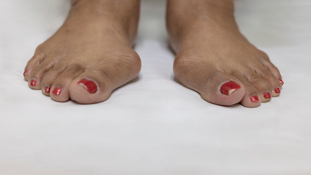 Bunions and what causes them