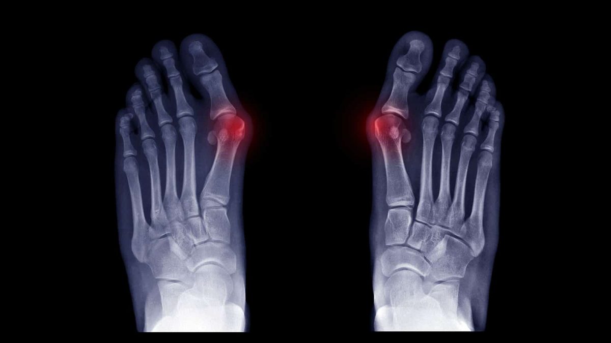 Big Toe Joint Pain Causes Bunions
