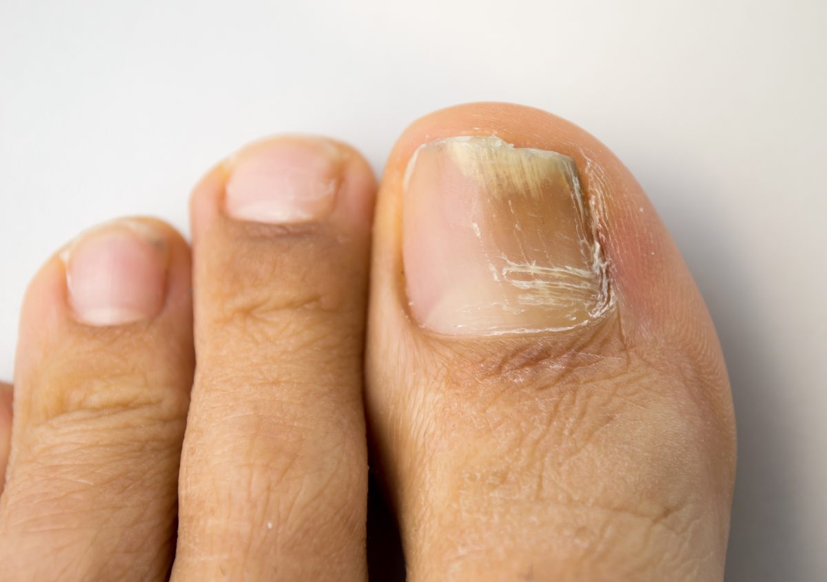 Nail Surgery and Curing an Ingrown Toenail in the High Peak and Derbyshire  Dales – Care For Feet