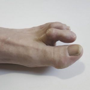 Cosmetic Hammertoe Surgery Options