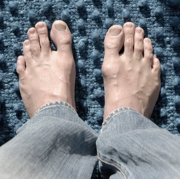 Aesthetic Toe Surgeries  Toe Shortening And Toe Lengthening