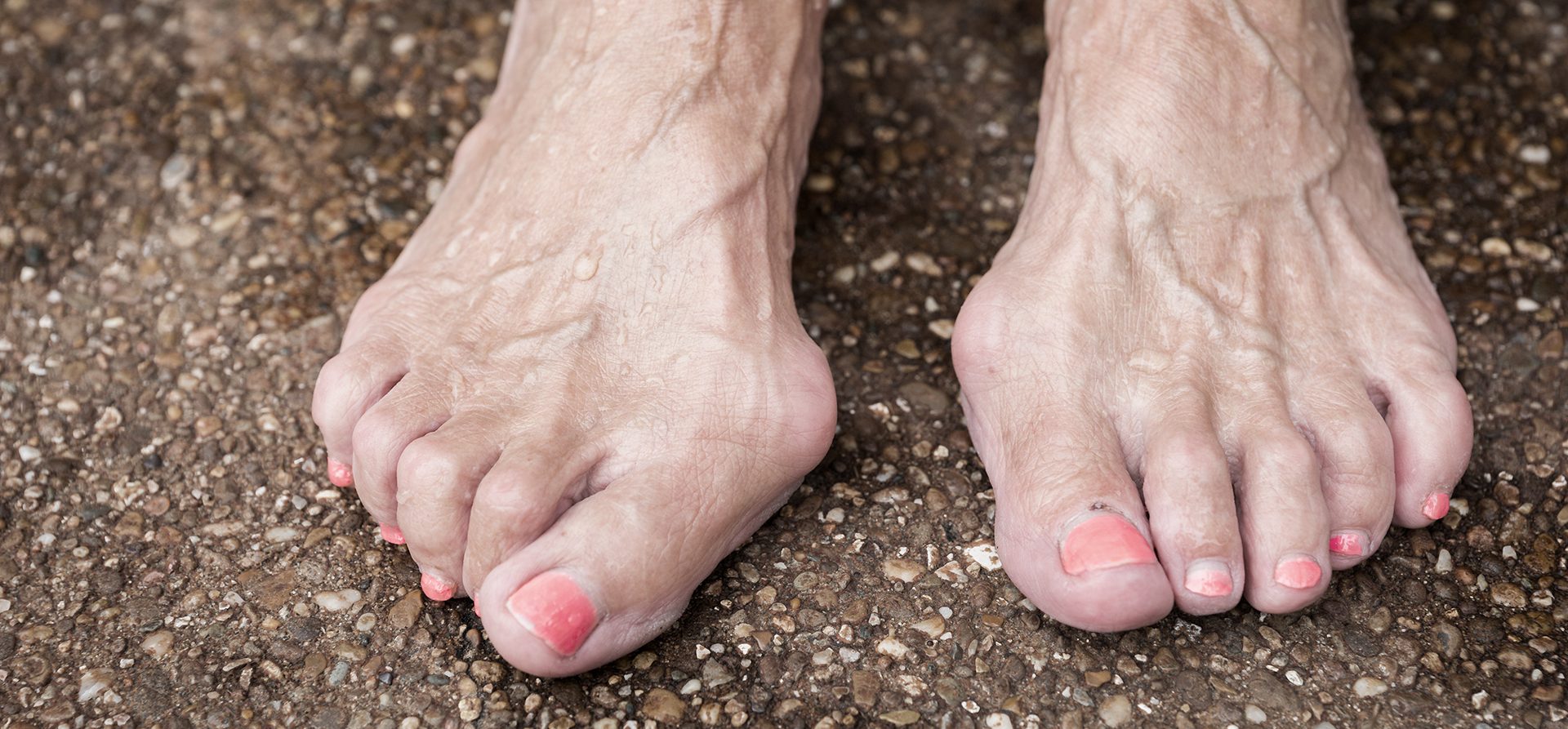 What is a bunion? And other common questions about bunions - UChicago  Medicine