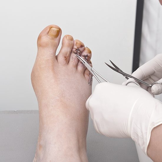Hammertoe Surgery Specialist, Foot Doctor