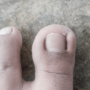 Ingrown toenail removal