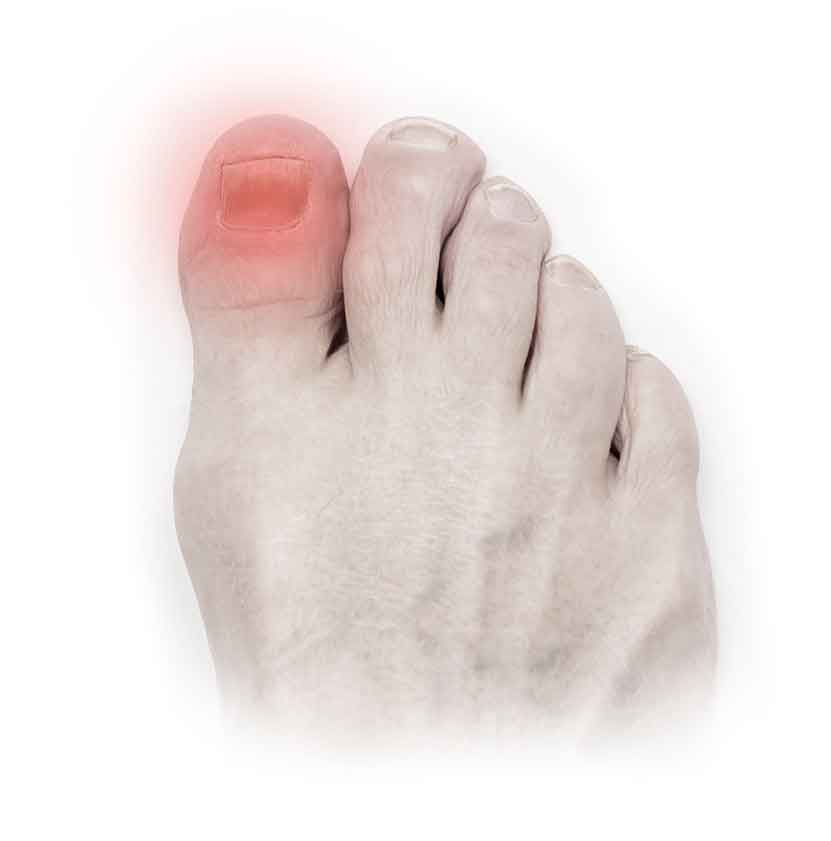 Toe Nail Fungus Treatments Surgical Removal Procedures