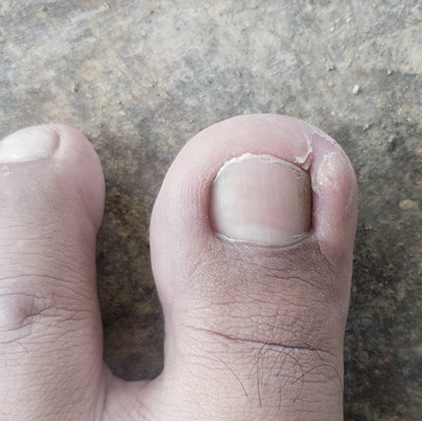 MKSAP Quiz: Pain in left great toe | ACP Internist