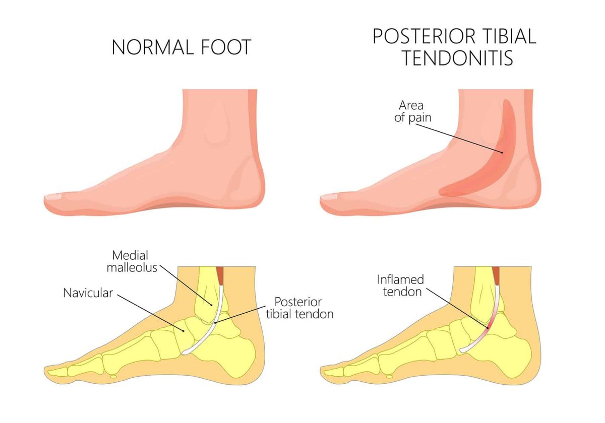 Posterior Tibial Tendonitis Symptoms Causes