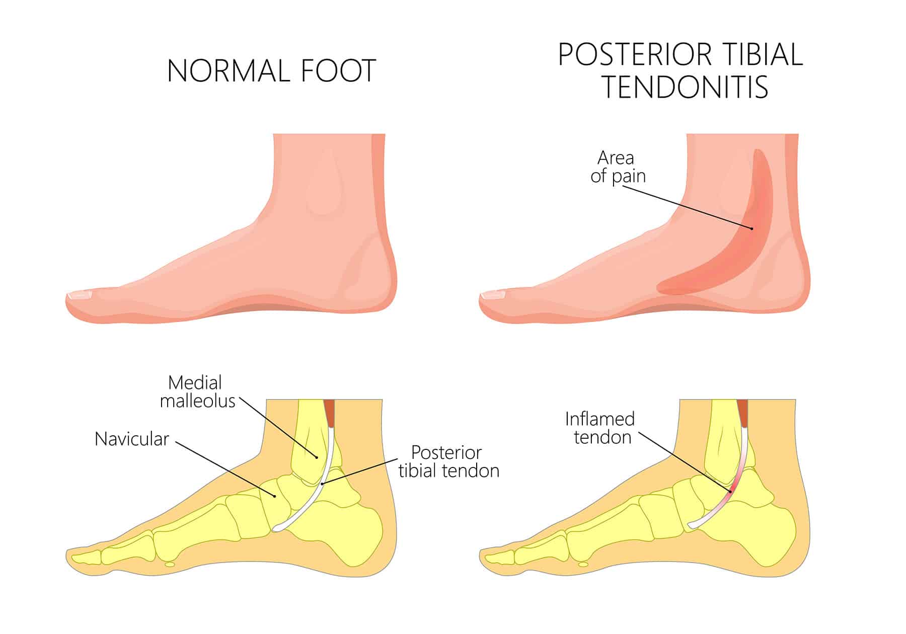 Muscle Pain in the Back of the Ankle [Best Achilles Tendonitis Treatment]