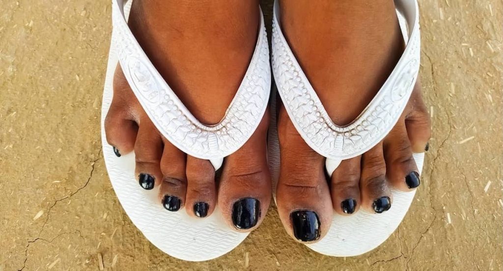 MinimallyInvasive Aesthetic Toe Shortening Surgery