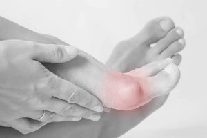 Cosmetic Functional Bunion Surgery