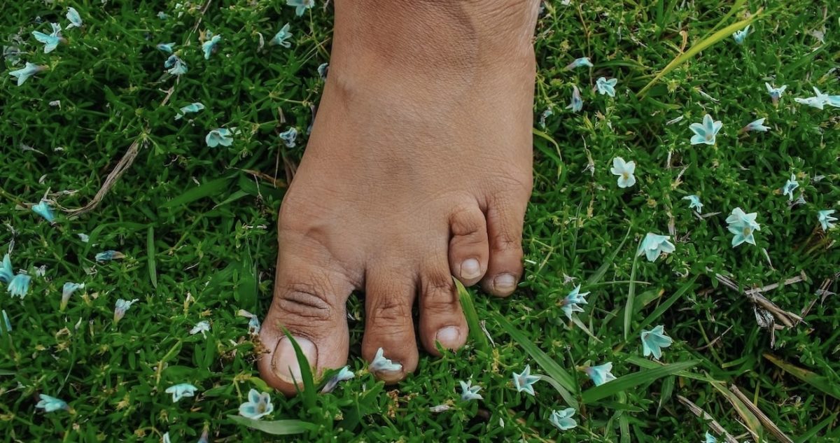 Brachymetatarsia Foot Surgery Short Toe